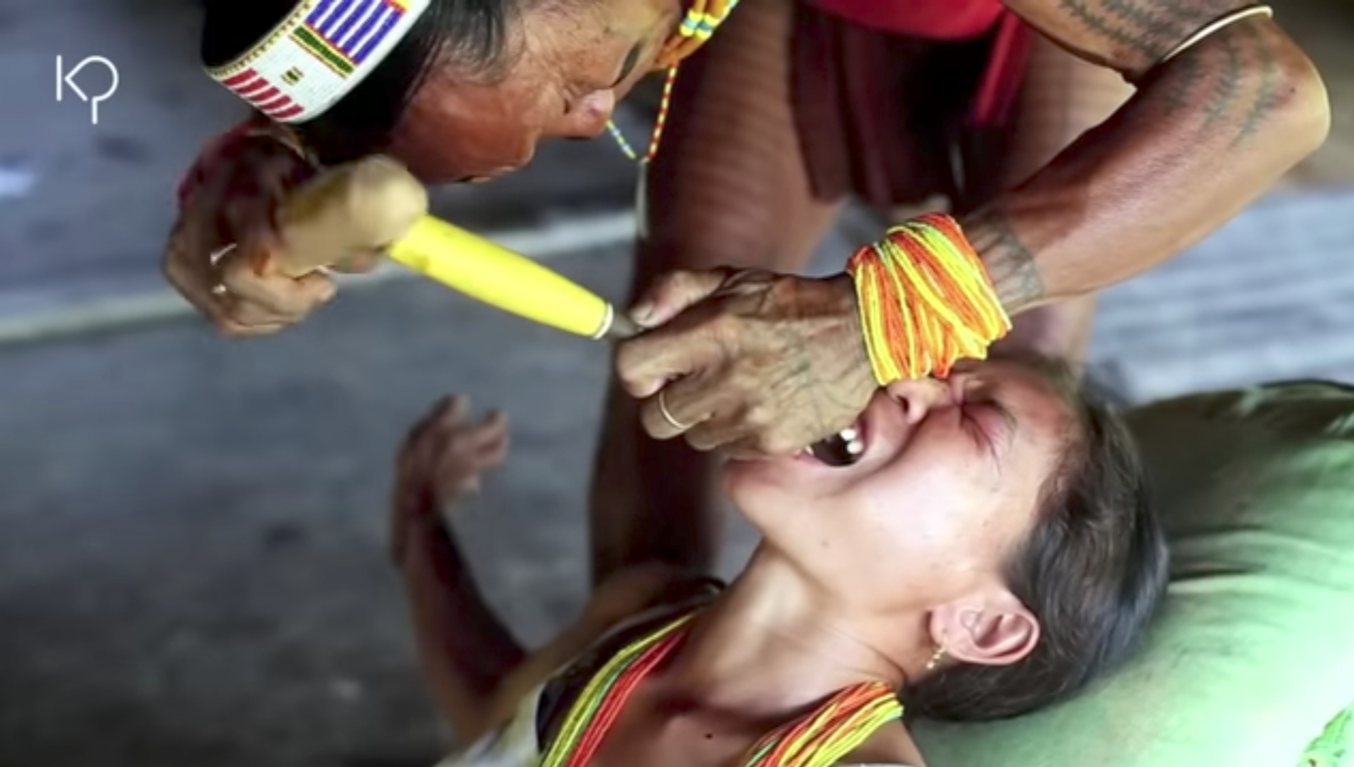 Tradisi Meruncingkan Gigi Suku Mentawai Agar Terlihat Cantik