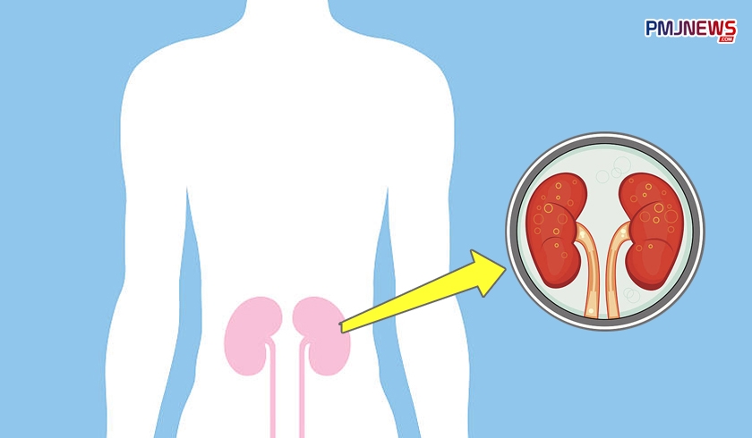 Begini 5 Cara Menjaga Ginjal Agar Tetap Sehat yang Wajib Diketahui Setiap Orang