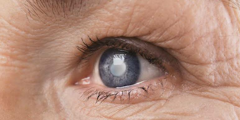 4 Tips Menjaga Kesehatan Mata dan Mencegah Katarak