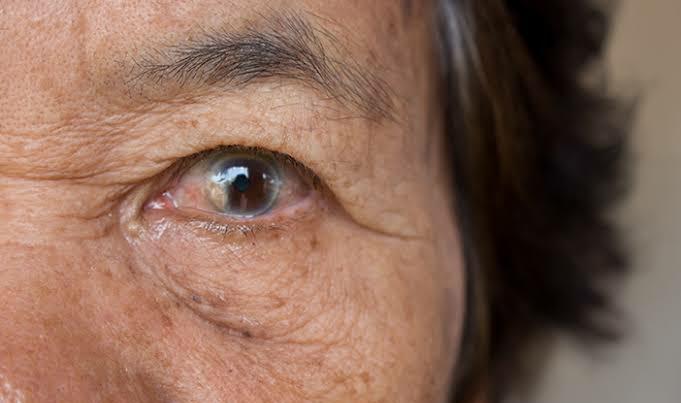 Waspada, Ini 4 Jenis Penyakit Mata yang Berisiko Muncul Pada Lansia
