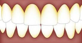 Cara Menghilangkan Karang Gigi Membandel Pakai 2 Bahan Alami di Rumah