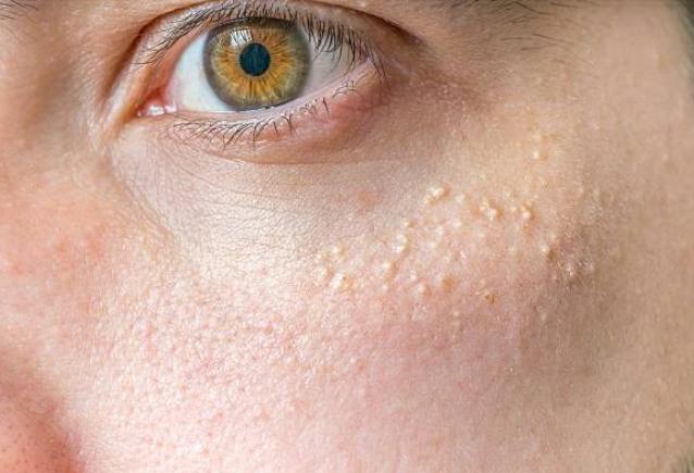 Get to Know Xanthoma: Causes and Treatment