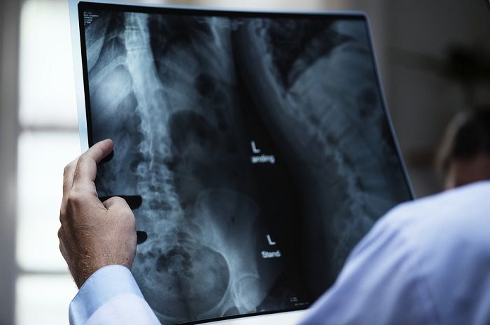 Cegah Risiko Osteoporosis dengan Langkah Berikut