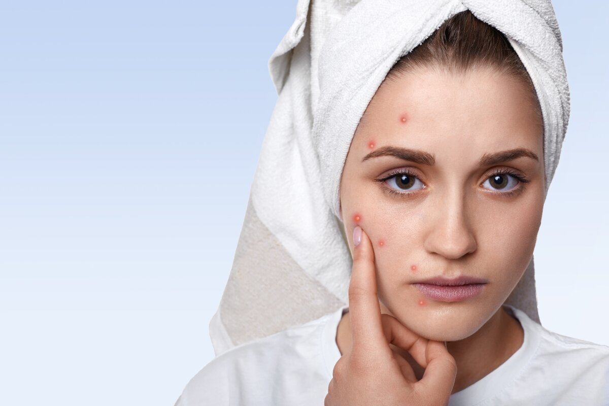 Produk Skincare yang Kamu Beli Justru Membuat Wajah Memburuk? Yuk Kenali Perbedaan Purging dan Breakout