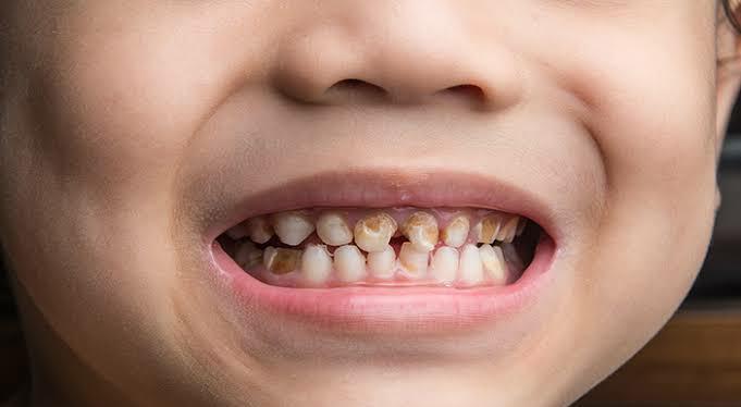 Kenali Bun, Ini 5 Tanda Gigi Anak Terkena Karies Sekaligus Penyebabnya