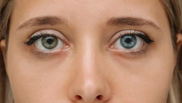 Tampil Percaya Diri Lewat 4 Tips Efektif Mencegah Mata Cekung