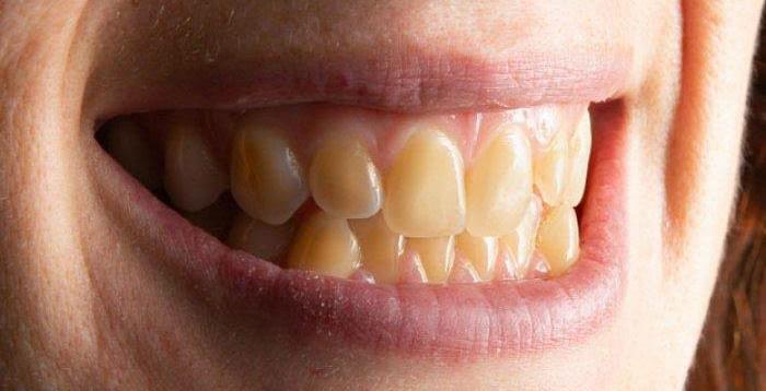5 Cara Cepat Memutihkan Gigi yang Kuning Tanpa Biaya Mahal