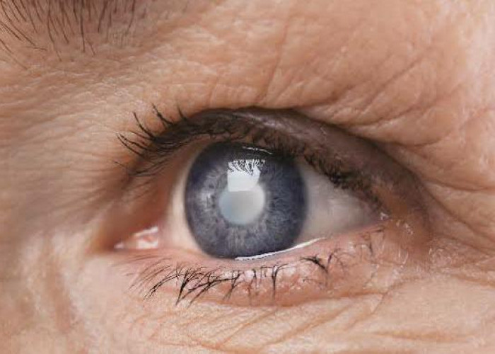 4 Tips Menjaga Kesehatan Mata dan Mencegah Katarak