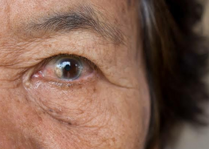 Waspada, Ini 4 Jenis Penyakit Mata yang Berisiko Muncul Pada Lansia