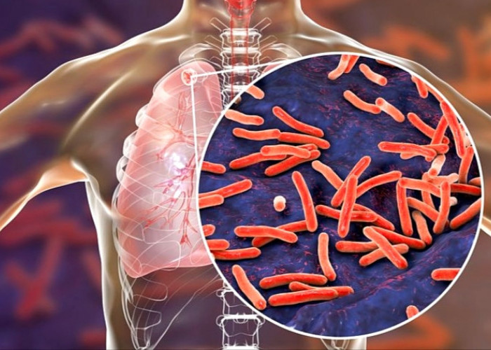 Waspada, Kenali Jenis Penyakit TBC Mengikuti Gejala yang Ditimbulkan