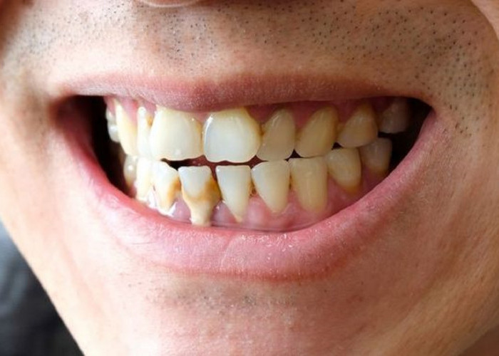 Mitos Dan Fakta Mengenai Cara Merontokkan Karang Gigi, Catat Segera!