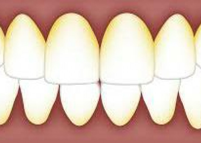 Cara Menghilangkan Karang Gigi Membandel Pakai 2 Bahan Alami di Rumah