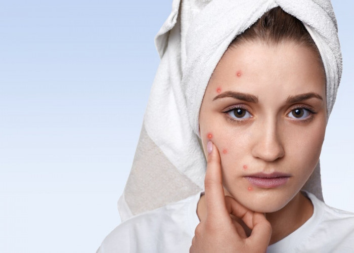 Produk Skincare yang Kamu Beli Justru Membuat Wajah Memburuk? Yuk Kenali Perbedaan Purging dan Breakout