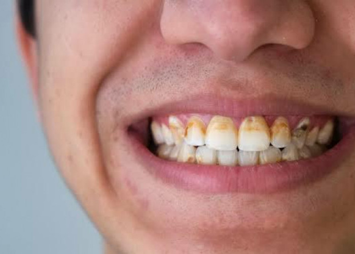Bersihkan Karang Gigi yang Sudah Mengeras Pakai 4 Obat Kumur Ini