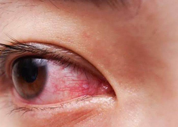 Jangan Sepelekan, Ini 5 Bahaya Mata Merah yang Tidak Boleh Diabaikan