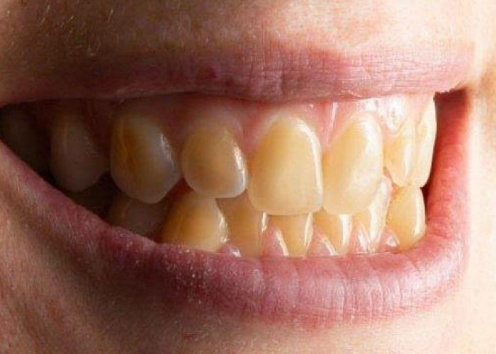 5 Cara Cepat Memutihkan Gigi yang Kuning Tanpa Biaya Mahal